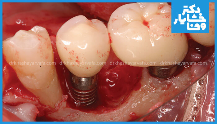دو ایمپلنت دندان کاشته شده به همراه روکش‌های موقت یا دائم در مجاورت دندان طبیعی، با قرمزی و خونریزی در لثه