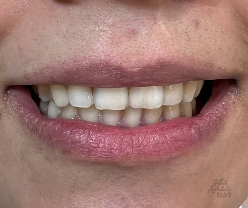 کامپوزیت دندان: نمونه کار اصلاح فاصله بین دندانهای قدامی (دیاستم) در کلینیک دکتر خشایار وفا