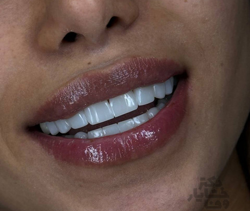 بهترین نمونه کار کامپوزیت دندان در یک جلسه: تغییر لبخند با کامپوزیت لوکس و ماندگار