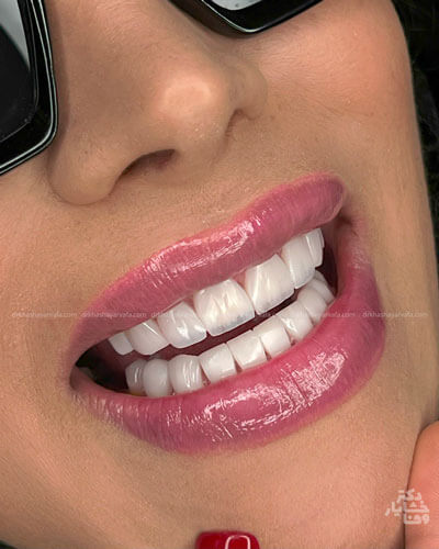 نمای نزدیک از لبها و دندانها پس از درمان ونیر کامپوزیت، با دندانهایی سفید، صاف و متقارن.