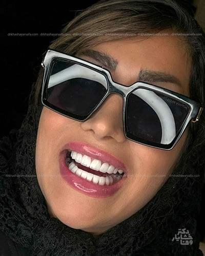 نمای جانبی دندانهای ونیر شده با کامپوزیت، نشان دهنده شکل و رنگ جدید دندانها.