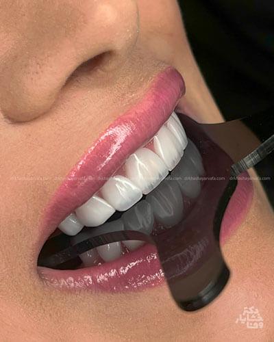 لبخند کامل پس از ونیر کامپوزیت، نشان دهنده زیبایی دندانها و لبخند درخشنده.