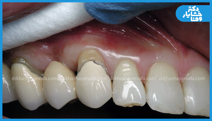 نمای نزدیک از دندان‌ها که ترمیم کامپوزیت شکسته یا ترک خورده روی دندان جلویی را نشان می‌دهد، با تغییر رنگ (لکه تیره) در زیر لبه ترمیم یا در خط لثه، که نشان‌ دهنده پوسیدگی ثانویه است.