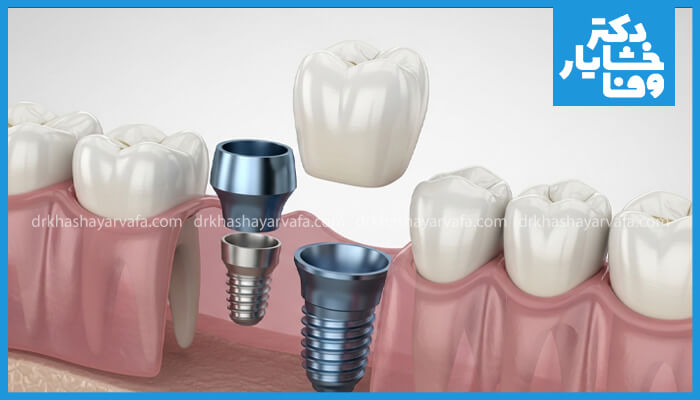 یک تصویر سه‌ بعدی و گرافیکی با نمای منفصل (Exploded View) از اجزای ایمپلنت دندان قدامی. این تصویر به طور واضح فیکسچر (پیچ)، اباتمنت (رابط)، و تاج (روکش سرامیکی) را به صورت جدا از هم نشان می‌دهد، در حالی که در محل لثه و استخوان فک جلویی (قدامی) قرار گرفته‌اند. این تصویر، سیستم سه بخشی ایمپلنت را نمایش می‌دهد.