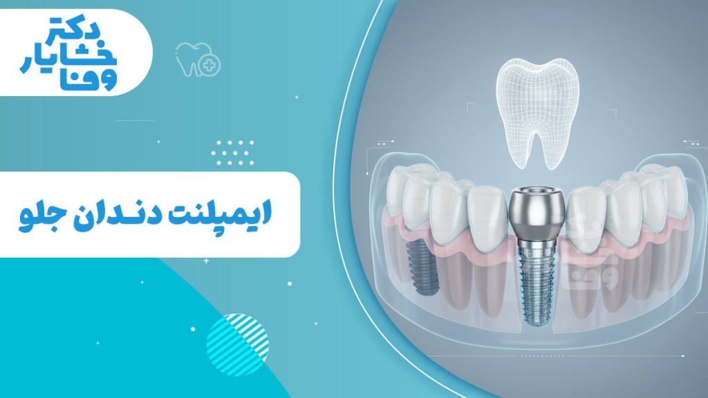 تصویر گرافیکی مفهومی برای ایمپلنت دندان جلو. این عکس شامل عنوان "ایمپلنت دندان جلو" است و یک فیکسچر ایمپلنت (پیچ فلزی) را در مرکز فک جلویی نشان می‌دهد که توسط دیگر دندان‌ها احاطه شده است. این تصویر بر جنبه فنی و ساختاری ایمپلنت قدامی تاکید دارد.