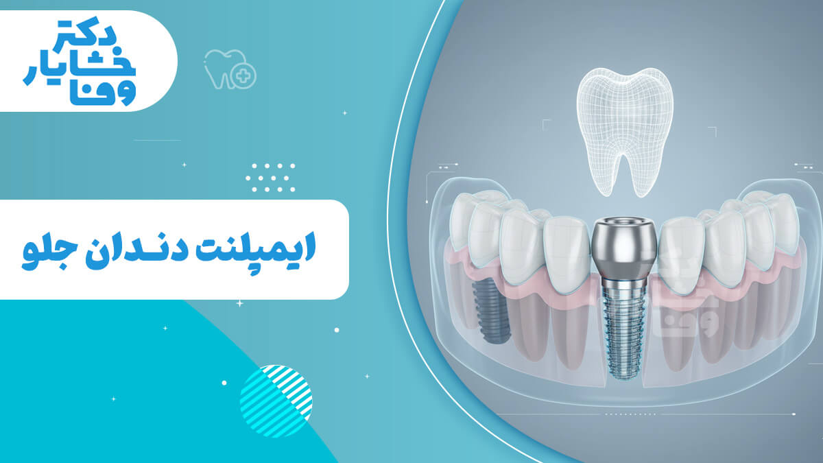 تصویر گرافیکی مفهومی برای ایمپلنت دندان جلو. این عکس شامل عنوان "ایمپلنت دندان جلو" است و یک فیکسچر ایمپلنت (پیچ فلزی) را در مرکز فک جلویی نشان می‌دهد که توسط دیگر دندان‌ها احاطه شده است. این تصویر بر جنبه فنی و ساختاری ایمپلنت قدامی تاکید دارد.