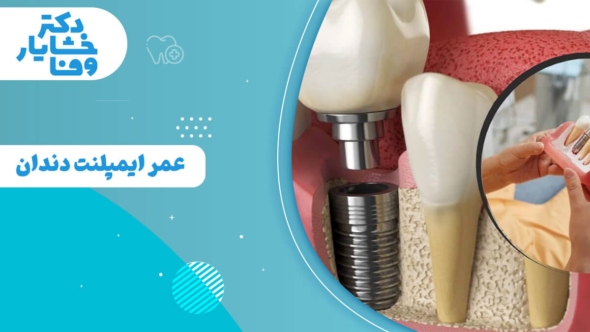 تصویر با عنوان"عمر ایمپلنت دندان" در پس‌زمینه‌ای آبی، همراه با نمای برش‌ خورده‌ای از ایمپلنت دندان کاشته شده در فک.