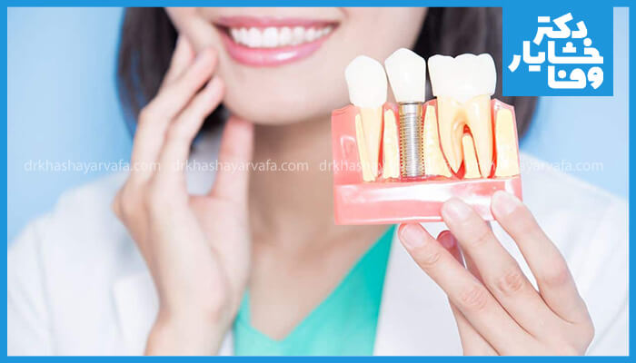 یک مدل تشریحی برش‌ خورده از ایمپلنت دندان در کنار دندان‌های طبیعی، که توسط دندانپزشک یا بیمار در پیش‌زمینه لبخند یک زن نگه داشته شده است.