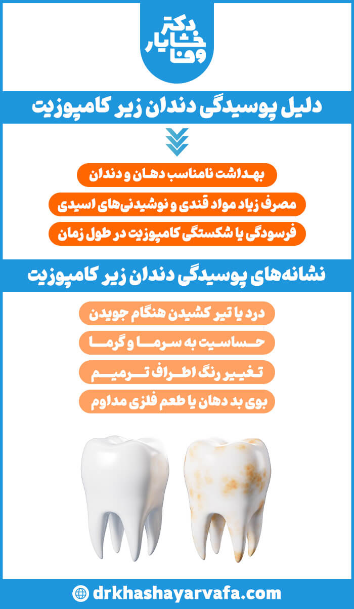 اینفوگرافیک عمودی با عنوان دلیل پوسیدگی دندان زیر کامپوزیت و نشانه‌های پوسیدگی دندان زیر کامپوزیت. شامل لیست علل مانند بهداشت نامناسب و علائم مانند حساسیت، تغییر رنگ به همراه مقایسه شماتیک دندان سالم و دندان دارای پوسیدگی.