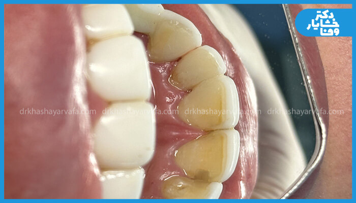 نمای داخلی زبانی دندان‌های جلویی که پوشش کامپوزیت سفید دارند، اما در قسمت داخلی یا لبه لثه، تغییر رنگ زرد/ قهوه‌ای و چسبندگی پلاک مشاهده می‌شود که احتمال نفوذ پوسیدگی را مطرح می‌کند.