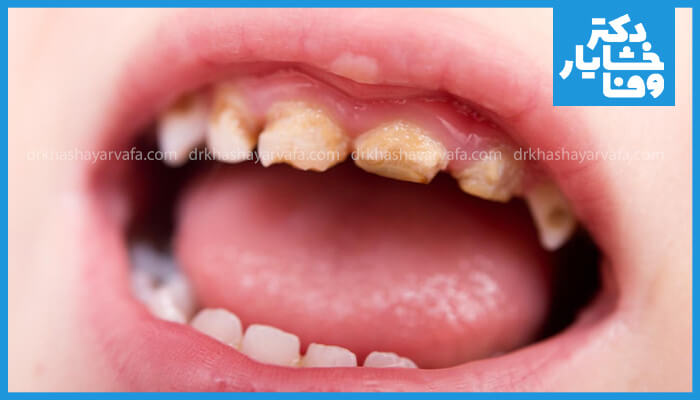 تصویر نزدیک از دندان‌های شیری جلویی کودک با پوسیدگی شدید (پوسیدگی دندان‌های شیری).