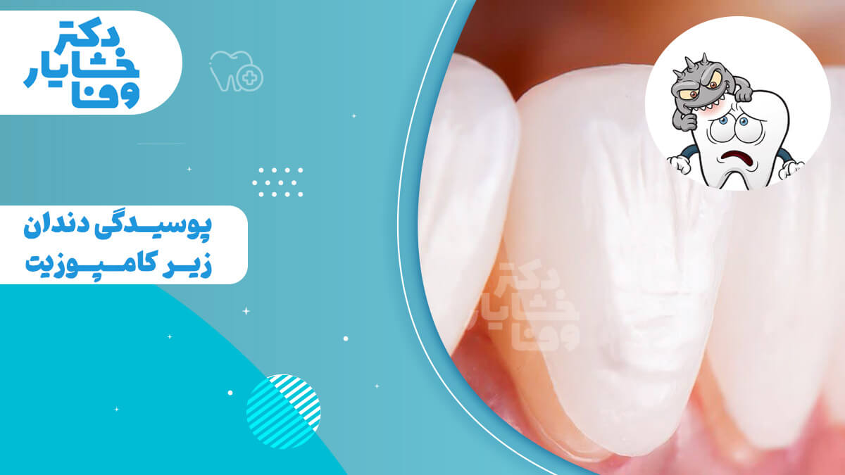 تصویر با تمرکز بر دندان‌های سفید کامپوزیت شده. یک طرح کارتونی از میکروب ترسناک روی یک دندان مضطرب، در کنار متن «پوسیدگی دندان زیر کامپوزیت» دیده می‌شود.