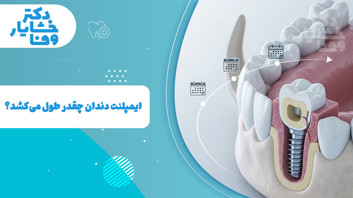 تصویر سه بعدی ایمپلنت در فک با عناصر تقویم برای نمایش مدت زمان درمان.