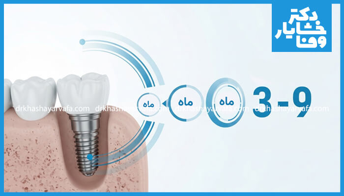 مدت زمان درمان ایمپلنت دندان فرآیند ۲ تا ۹ ماهه با نمایش بصری مراحل ماهانه.