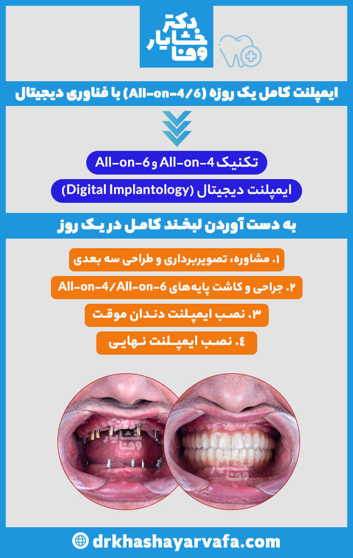 اینفوگرافیک مراحل ۴ گانه ایمپلنت کامل یک روزه (All-on-4/6) و نتایج قبل و بعد از نصب پروتز نهایی.