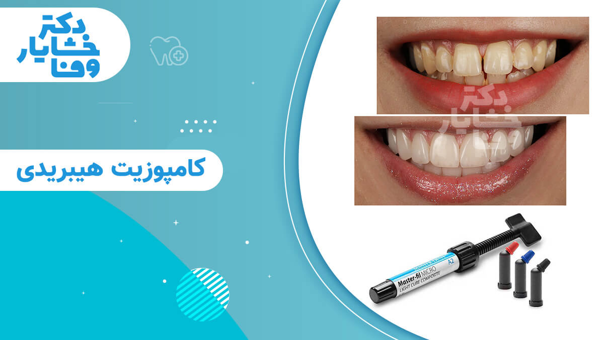 تصویر قبل و بعد از درمان کامپوزیت هیبریدی (ونیر کامپوزیت) برای اصلاح ظاهر و رنگ دندانها و ابزار کامپوزیت دندان.