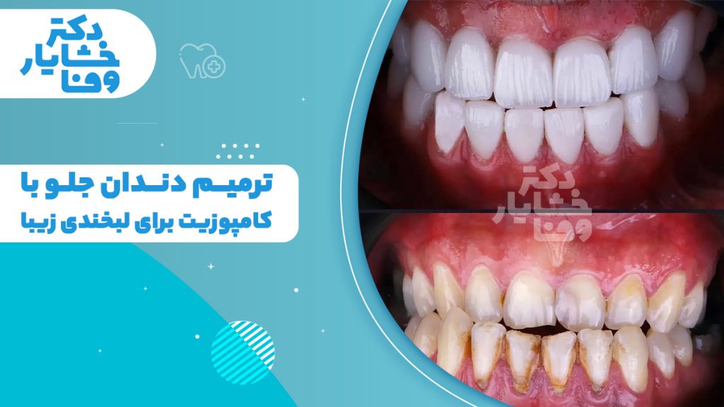 تصویر بنر با عنوان "آیا کاندید مناسبی برای کامپوزیت ونیر هستید؟" شامل نمای لبخند و ابزار دندانپزشکی.