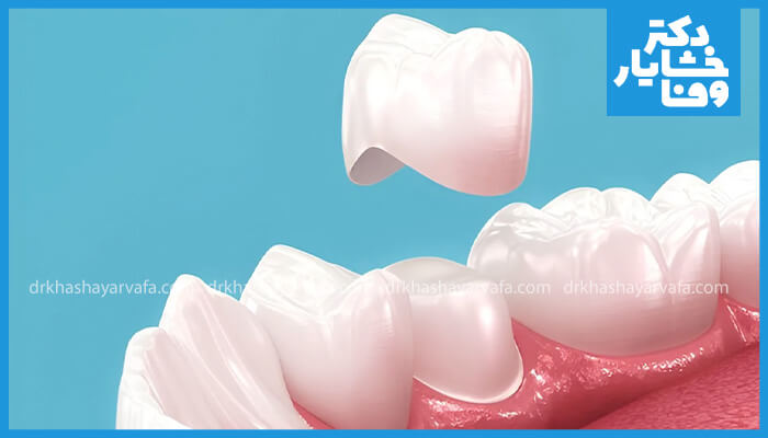 روکش دندان سرامیکی در حال نصب روی یک دندان. نمایش کیفیت و تناسب روکش.