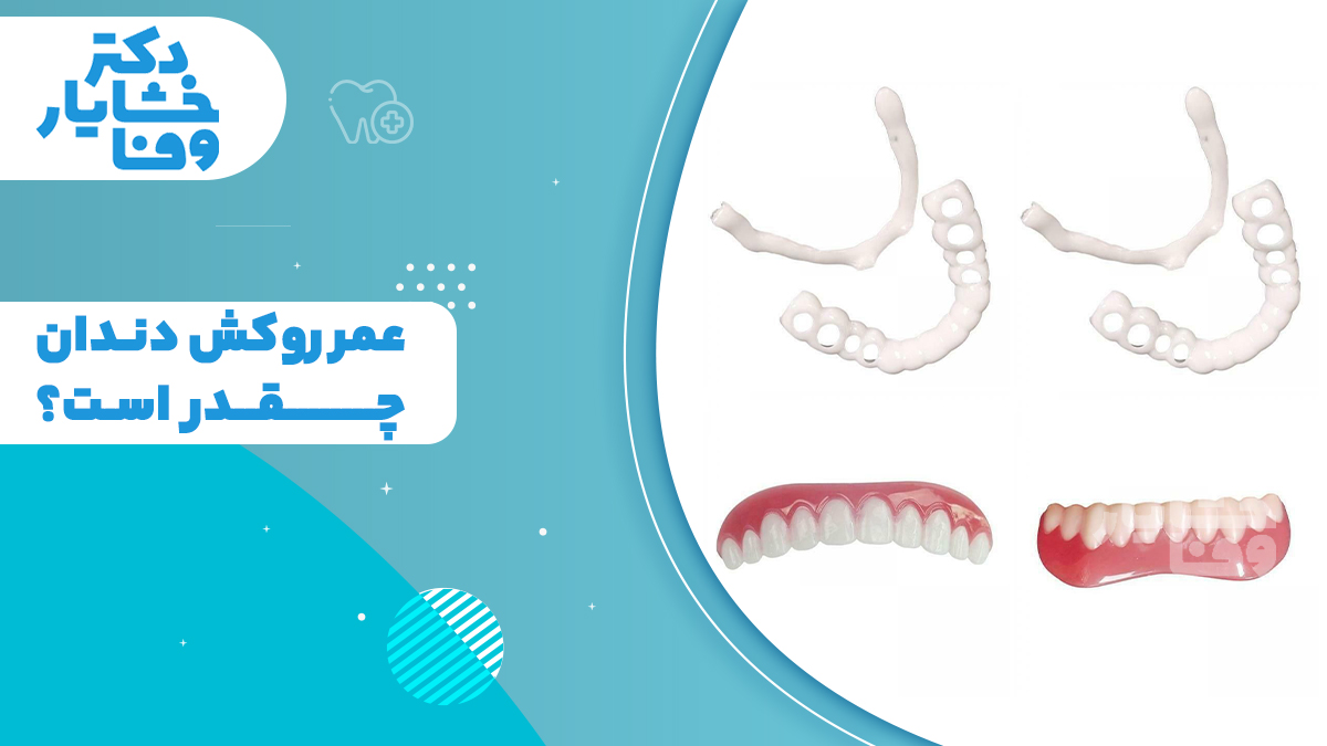 انواع روکش و پروتز دندان و بررسی اینکه عمر روکش دندان چقدر است