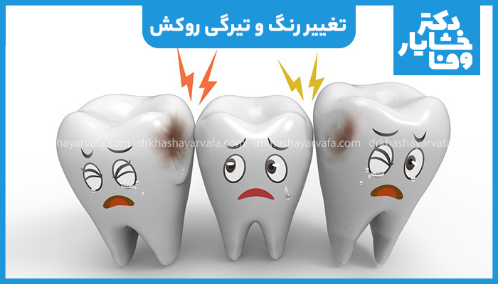 تصویر کارتونی نشان‌ دهنده تغییر رنگ، تیرگی و پوسیدگی دندان به عنوان علائم نیاز به تعویض روکش