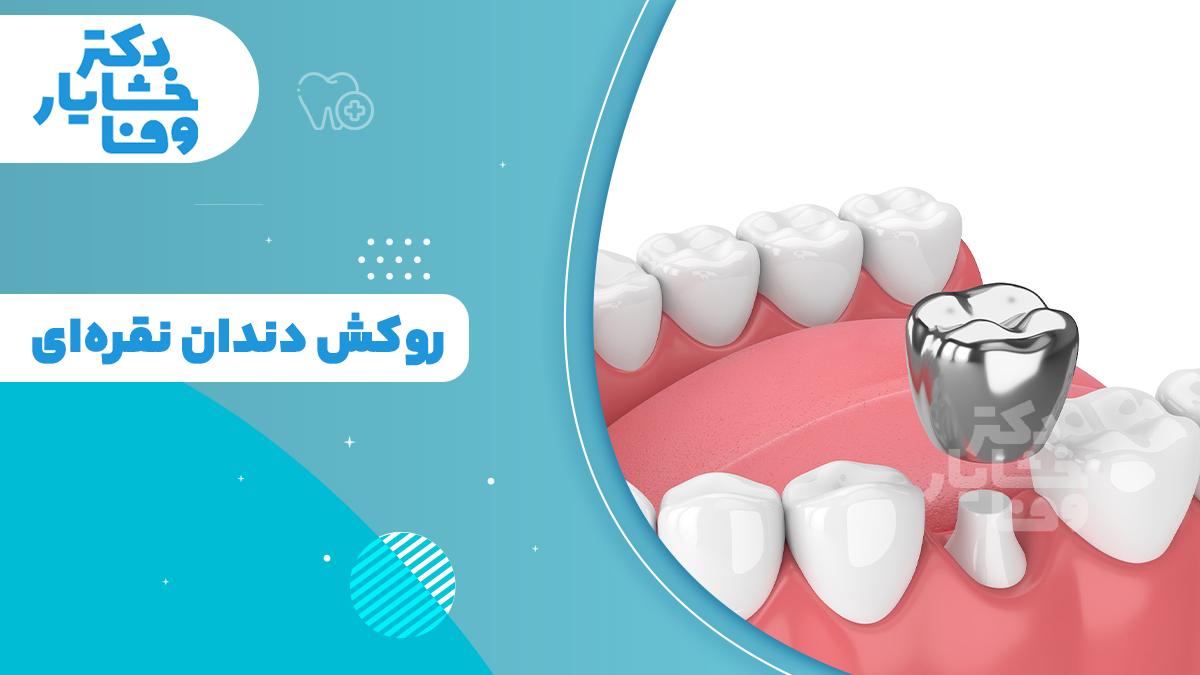 تصویر سه‌ بعدی از نحوه قرارگیری و نصب روکش نقره‌ای روی پایه دندان تراش‌ خورده