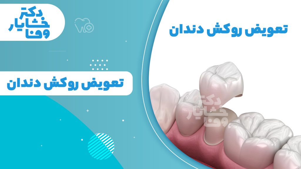 تصویر خدمات تعویض روکش دندان در مطب دکتر خشایار وفا در سهروردی شمالی - تهران