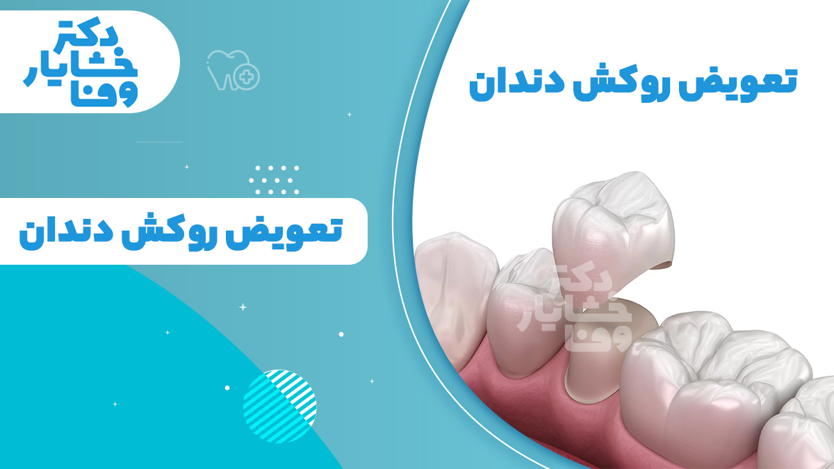 تصویر خدمات تعویض روکش دندان در مطب دکتر خشایار وفا در سهروردی شمالی - تهران