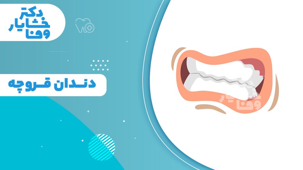 دندان‌ قروچه و اثر سایش دندان‌های فک بالا و پایین