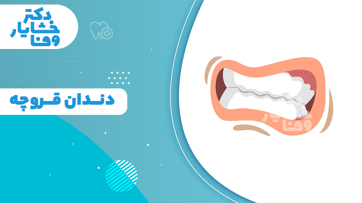 دندان‌ قروچه و اثر سایش دندان‌های فک بالا و پایین