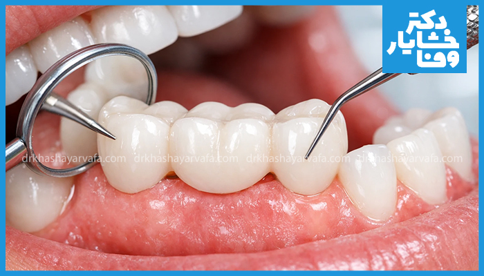 بررسی و معاینه بریج دندان توسط دندانپزشک برای تشخیص معایب و مشکلات بریج دندان مانند لق شدن بریج، التهاب لثه و پوسیدگی دندان پایه