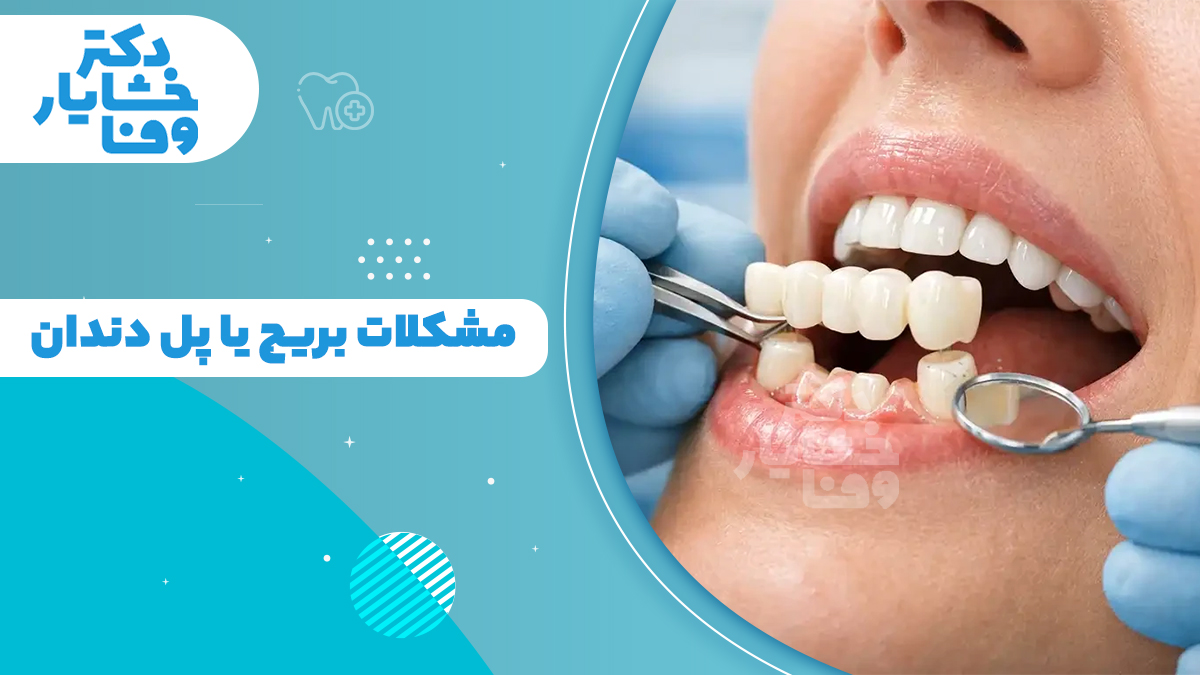 معایب و مشکلات بریج دندان در هنگام معاینه؛ بررسی پوسیدگی زیر بریج و التهاب لثه