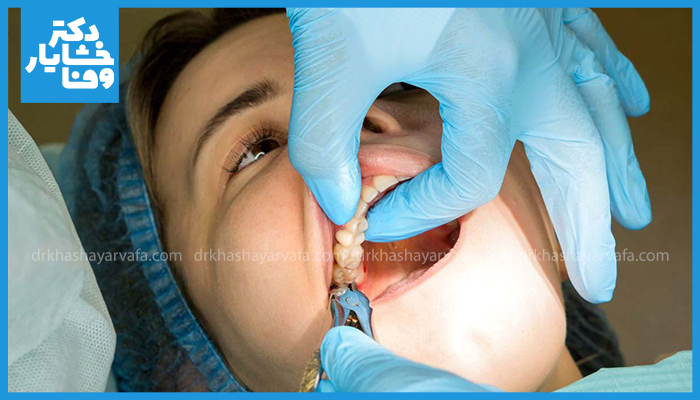 مراحل کشیدن دندان توسط دندانپزشک با استفاده از ابزار تخصصی در مطب دندانپزشکی