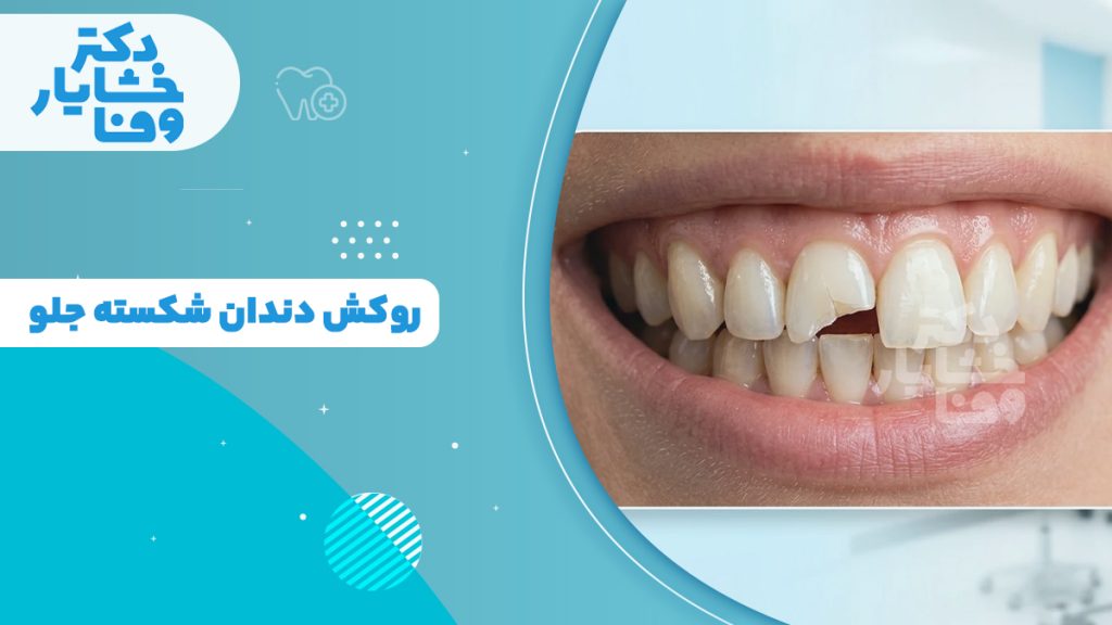 دندان جلو شکسته که روکش دندان روی آن قرار گرفته و ظاهر طبیعی به آن داده است.