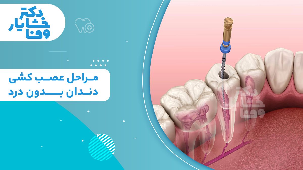 مراحل عصب کشی دندان بدون درد، همراه با تصویرسازی سه بعدی از ورود ابزار دندانپزشکی به ریشه شفاف یک دندان آسیاب در ردیف دندان‌ها.
