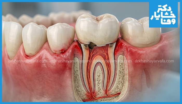 تصویر آناتومی پوسیدگی دندان زیر روکش و التهاب شدید لثه و ریشه