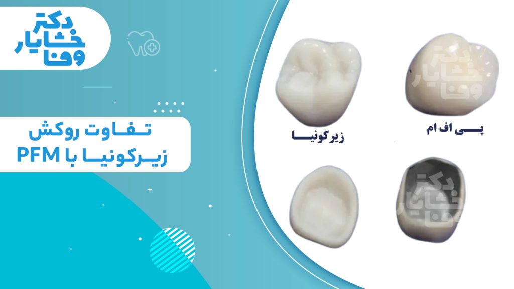 تفاوت روکش زیرکونیا با PFM که ظاهر بیرونی و ساختار داخلی سفید رنگ روکش زیرکونیا را با فلز تیره داخلی روکش پی اف ام مقایسه می‌کند.