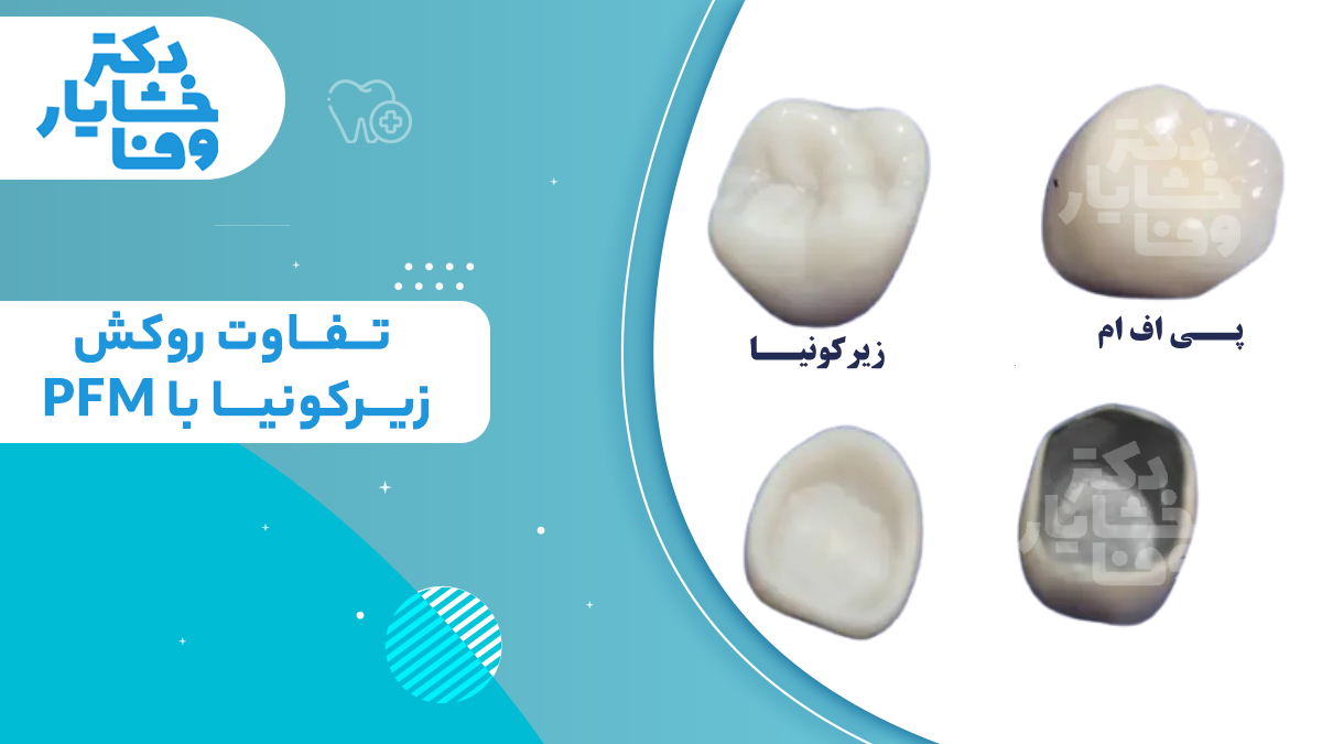 تفاوت روکش زیرکونیا با PFM که ظاهر بیرونی و ساختار داخلی سفید رنگ روکش زیرکونیا را با فلز تیره داخلی روکش پی اف ام مقایسه می‌کند.
