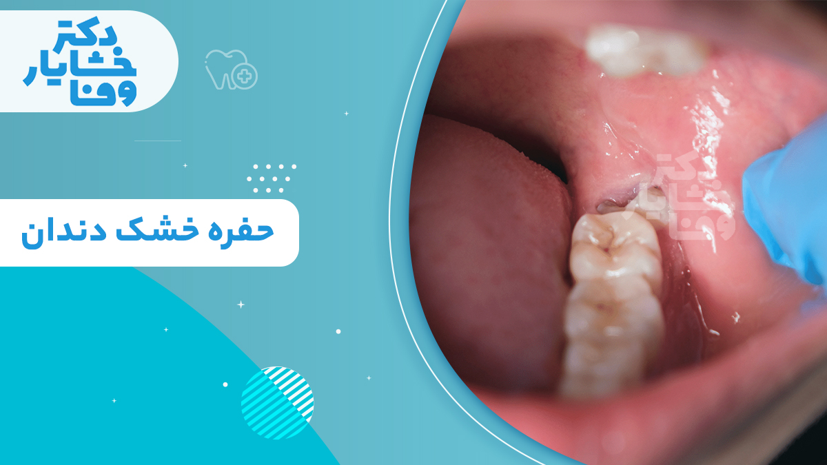 حفره خشک دندان همراه با تصویر واقعی از داخل دهان و محل دندان عقل کشیده شده، دکتر خشایار وفا