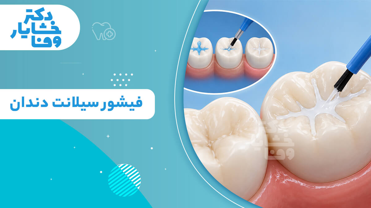 مراحل استفاده از برس برای اعمال مواد فیشور سیلانت روی سطح دندان