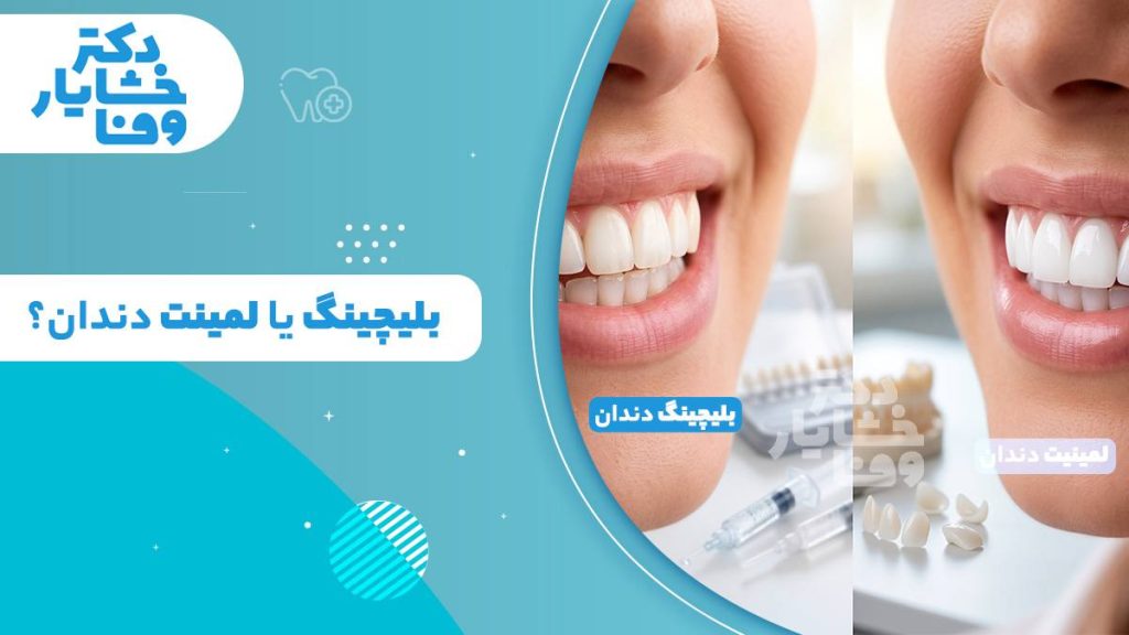مقایسه بلیچینگ دندان و لمینت دندان در تصویر شاخص مقاله