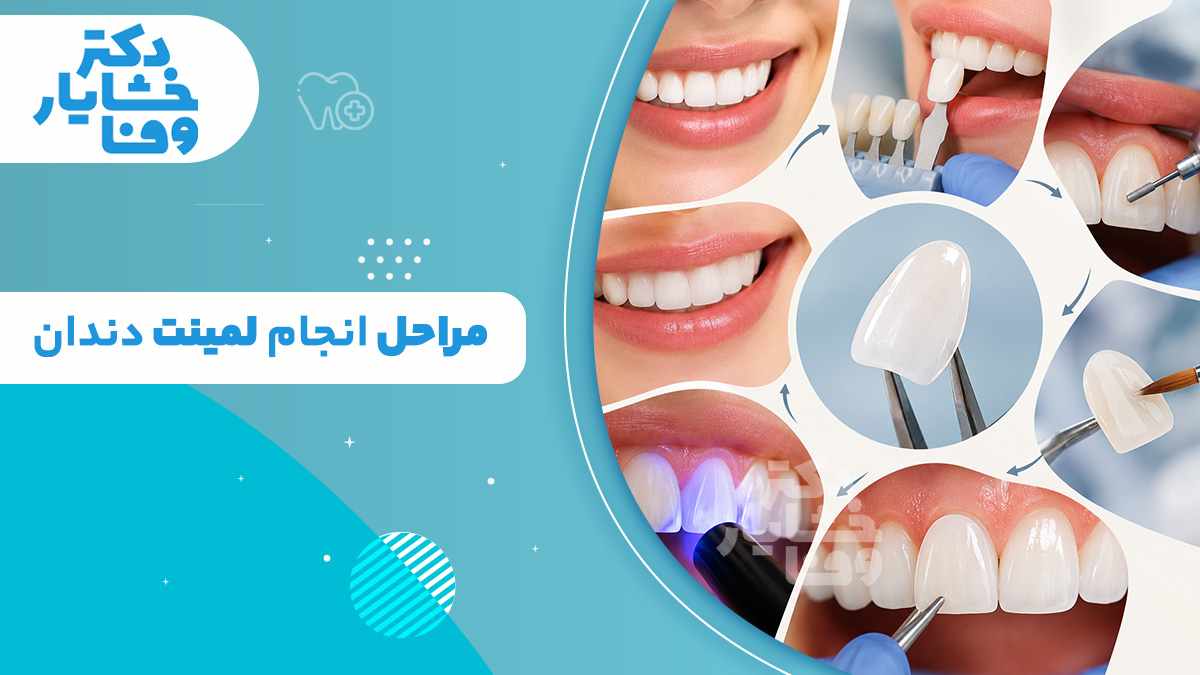 مراحل انجام لمینت دندان از معاینه تا نصب ونیر
