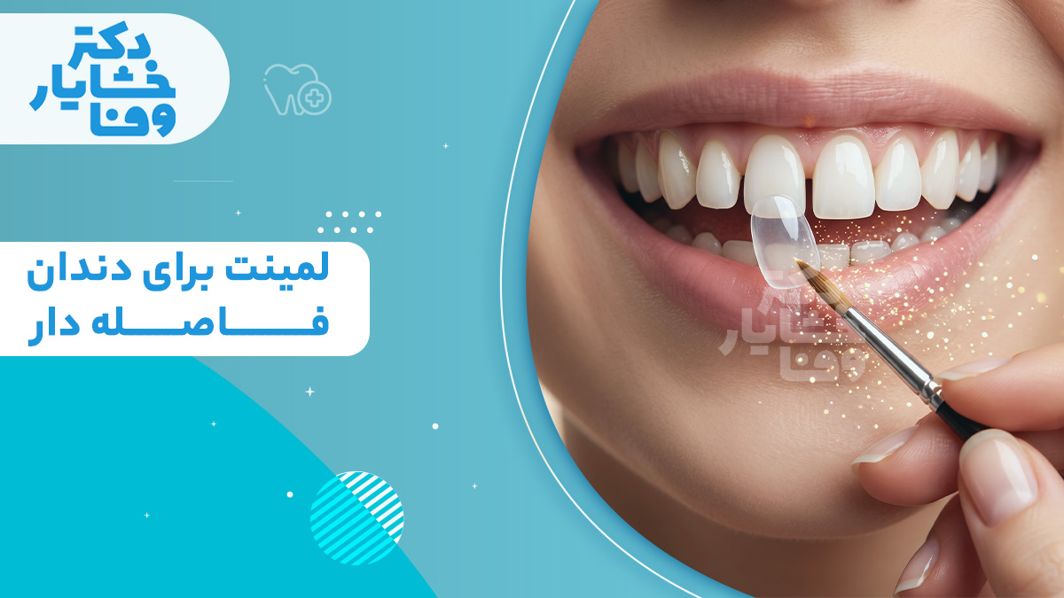 خدمات لمینت برای دندان‌های فاصله‌دار با تصویر لبخند زیبا و نصب لمینت