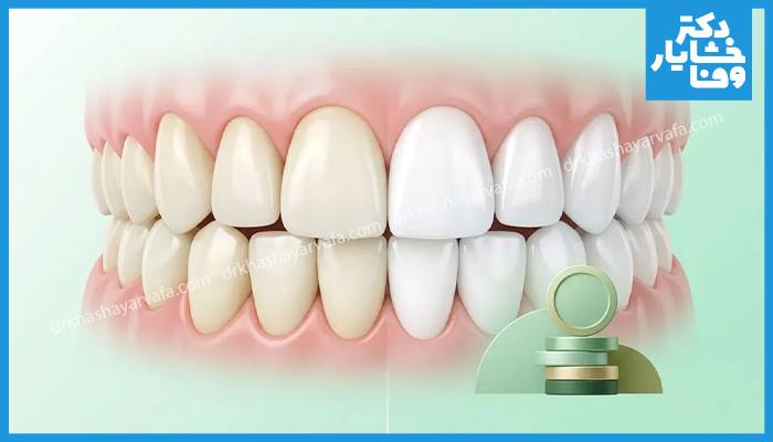 تصویر مقایسه ظاهر دندان ها در بلیچینگ و لمینت