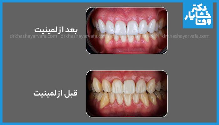 نمونه تصویری قبل و بعد لمینت دندان